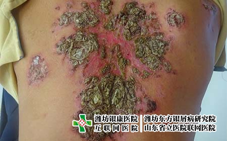 身上長牛皮癬是怎么回事