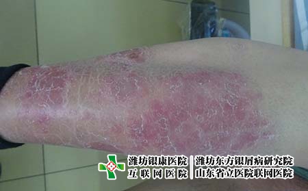 青島牛皮癬好醫院在哪里呢