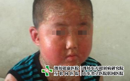 青少年患牛皮癬有怎樣的特點