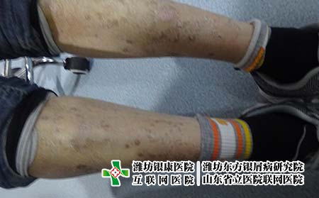 濟南治療銀屑病什么醫院好 濟南治療銀屑病什么醫院好