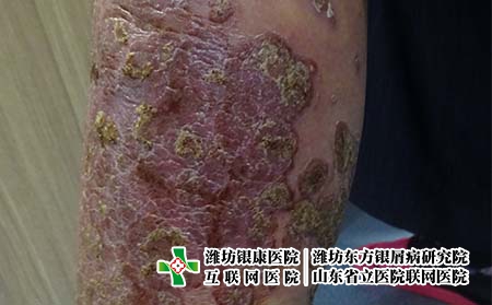 濰坊治療牛皮癬的醫院那里好?