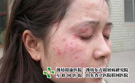 怎樣醫治女性臉上的銀屑病