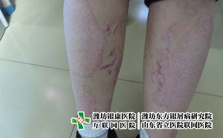 治療牛皮癬時應該注意什么呢 治療牛皮癬時應該注意什么呢