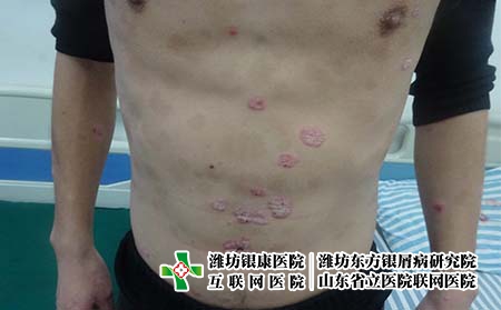 全身牛皮癬怎么治療好