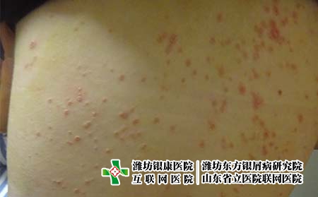 平時怎么才能減少牛皮癬的反復(fù)