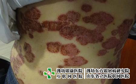 治療牛皮癬青島那個醫院較好?