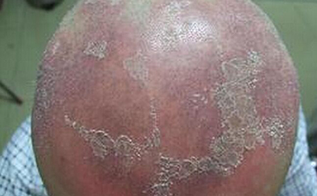 銀屑病患者在日常生活中掉頭發(fā)的原因是什么