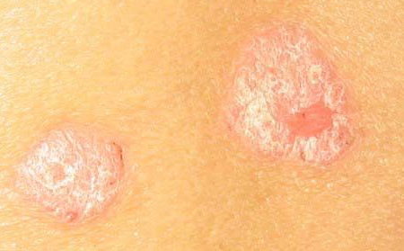 警惕!正確對(duì)待點(diǎn)滴型銀屑病初期癥狀表現(xiàn)