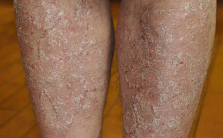 銀屑病采取什么方法可以控制蔓延