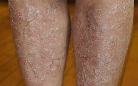 銀屑病患者在日常護理中應該遵循的原則有哪些