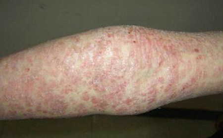 尋常型銀屑病各時期可以轉跡象的特征有哪些