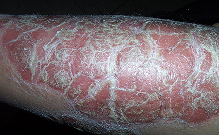 防止遺傳性銀屑病的方法有哪些