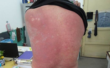 銀屑病提高恢復(fù)幾率的方法有哪些