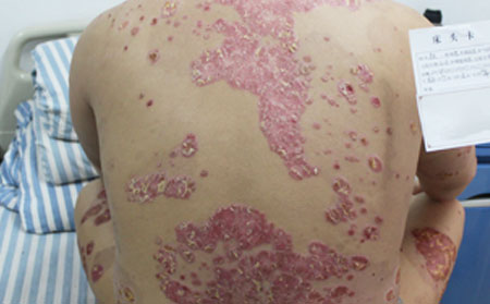 性格影響銀屑病