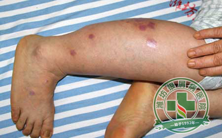 銀屑病預防護理