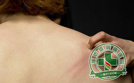 秋季銀屑病患者如何止癢