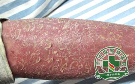 秋季銀屑病防復發的預防