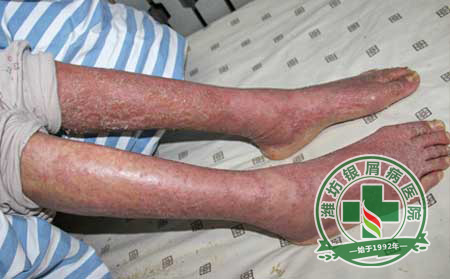 銀屑病護(hù)理