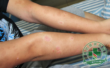 濰坊銀屑病醫院