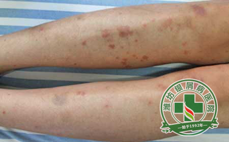 秋季銀屑病護理