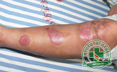 銀屑病護(hù)理方法
