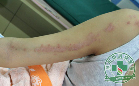 銀屑病護理