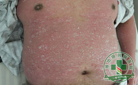 銀屑病預(yù)防