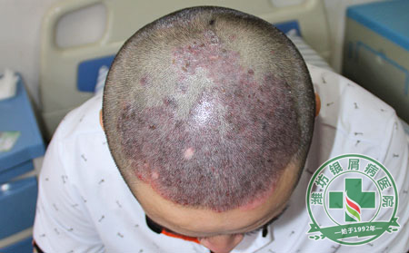 頭部銀屑病
