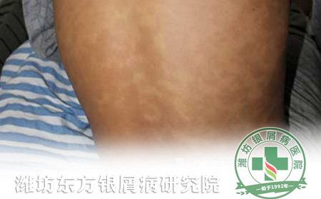 如何對銀屑病患者進(jìn)行心理護(hù)理