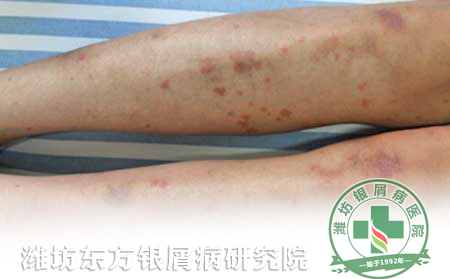 醫(yī)生淺談秋季銀屑病護理方法