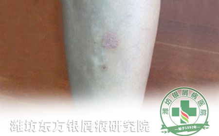 銀屑病進入消退期時如何通過護理鞏固治療效果