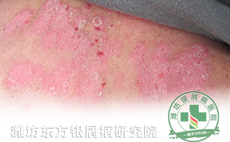 立秋后如何預(yù)防銀屑病出現(xiàn)加重