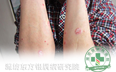 銀屑病醫(yī)療方面的護理應該怎樣進行