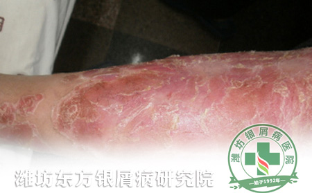 銀屑病患者怎么改善局部皮損