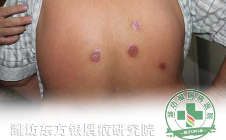 隱私部位牛皮癬如何護理