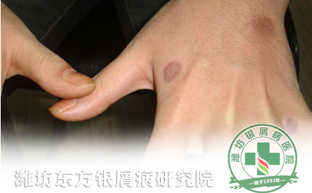 手部銀屑病如何科學(xué)護理