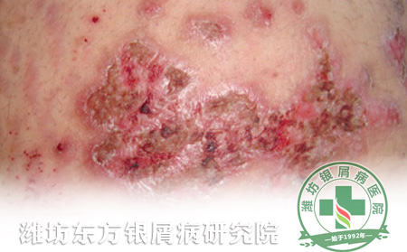 如何預(yù)防銀屑病病情惡化