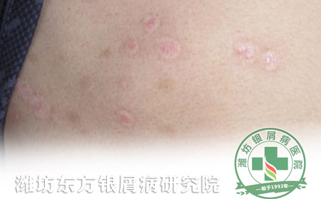消退期銀屑病護理要注意哪些方面的問題