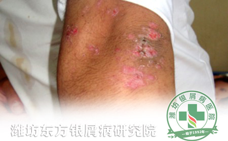 得了關節(jié)型牛皮癬怎樣護理？