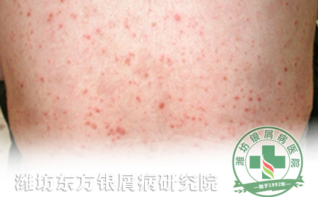 牛皮癬護(hù)理的幾大要點(diǎn)