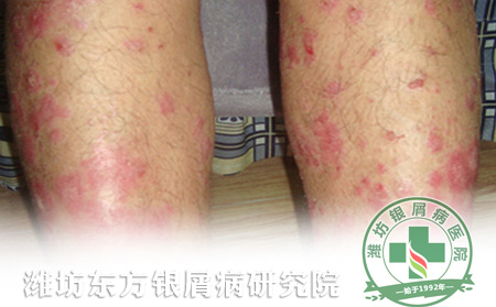 腿上長了牛皮癬怎么護理可以