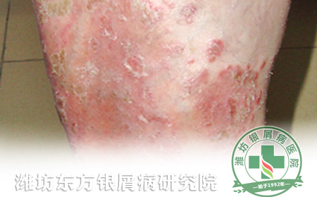 重癥銀屑病怎么護理可以