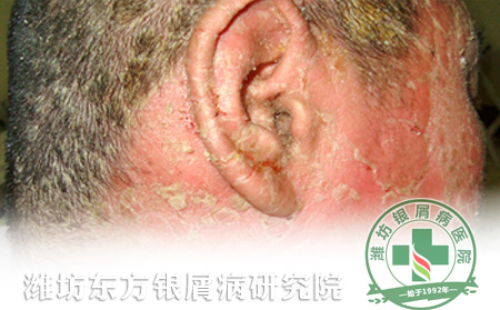 頭部牛皮癬有哪些護理方法