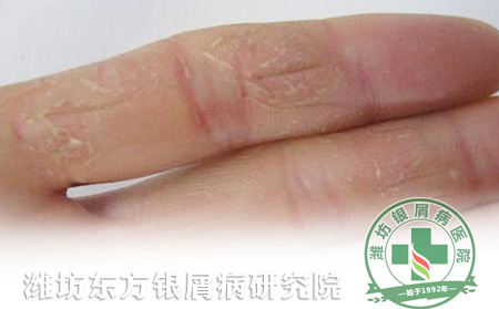 牛皮癬皮損干裂怎么護理