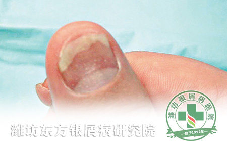 濰坊東方銀屑病研究院春季牛皮癬復(fù)發(fā)征兆