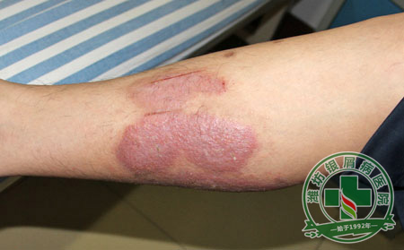 銀屑病護(hù)理