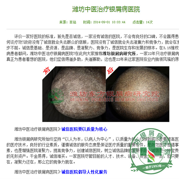 濰坊銀屑病醫院