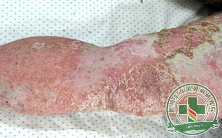 銀屑病的遺傳概率