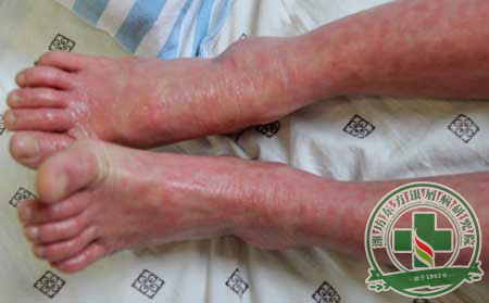 紅皮病型銀屑病