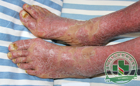 關(guān)節(jié)型銀屑病3條注意